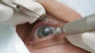 Médicos alertam para riscos de cirurgia de mudança da cor dos olhos
