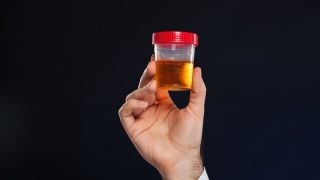 10 situações preocupantes indicadas pela urina escura, incluindo câncer